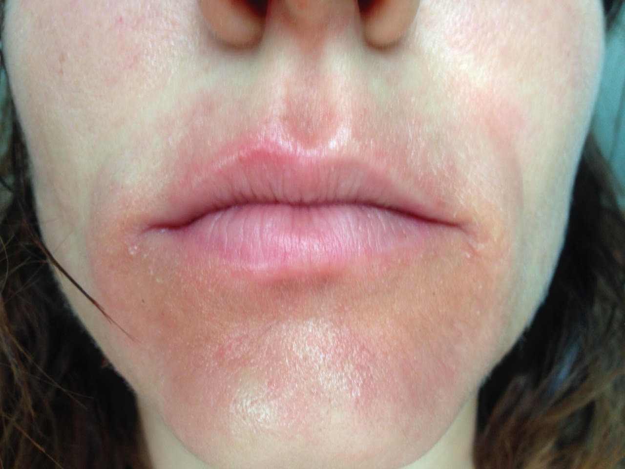 De quoi il y a un eczéma sur la main