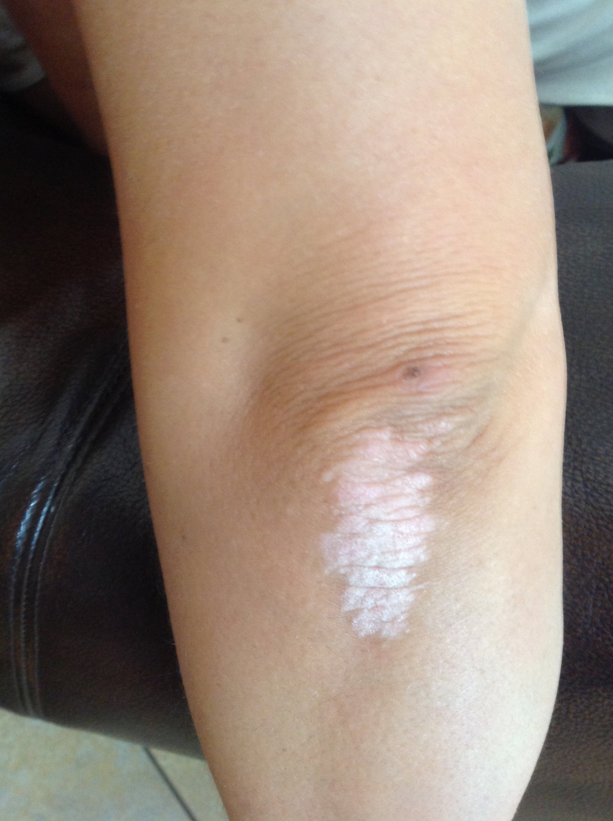 Si on peut visiter le sauna au psoriasis