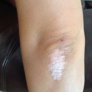 Le traitement du psoriasis boutonneux sur les paumes